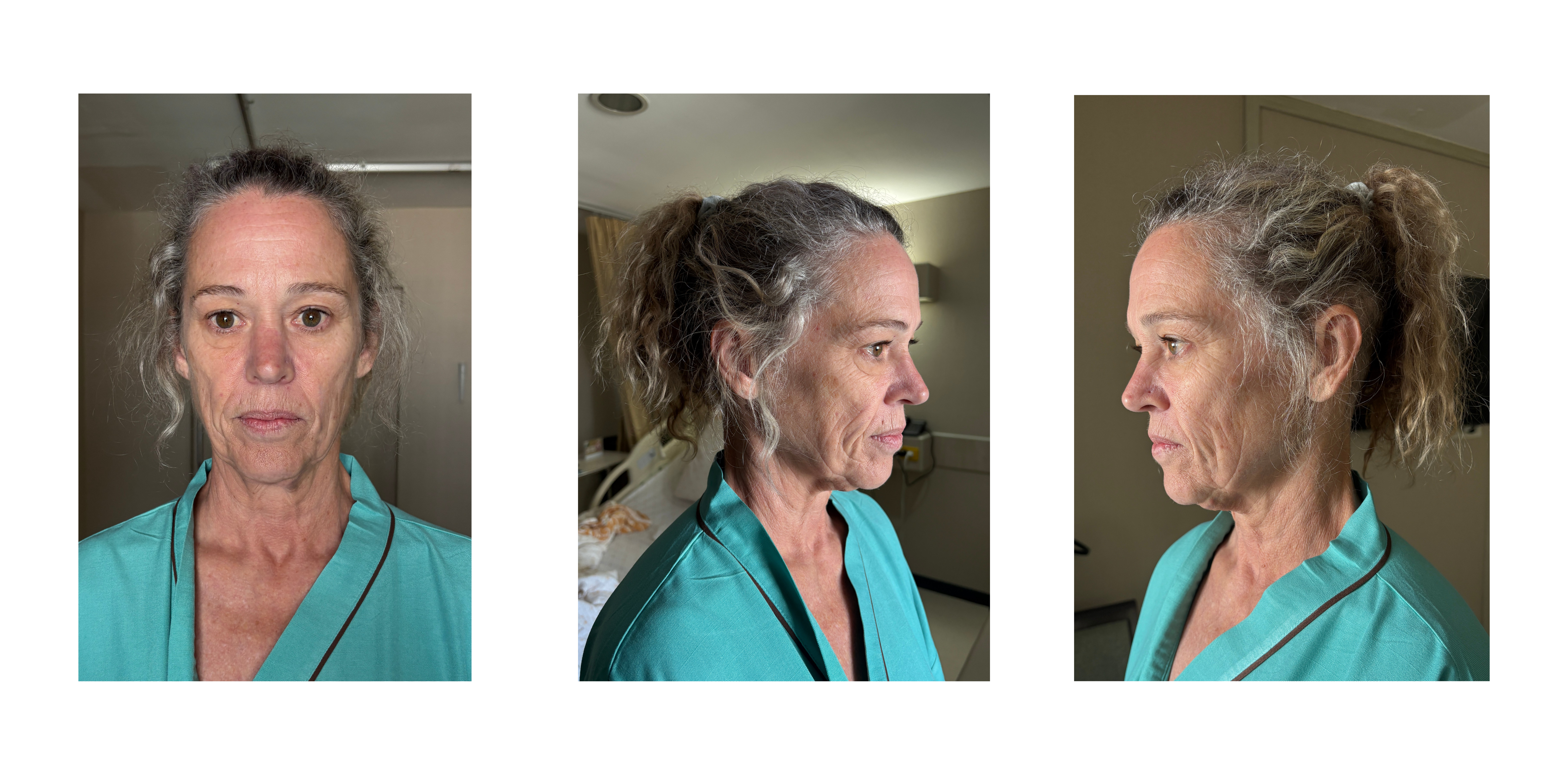 Facelift photos guideline